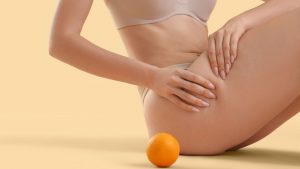 rimedi cellulite