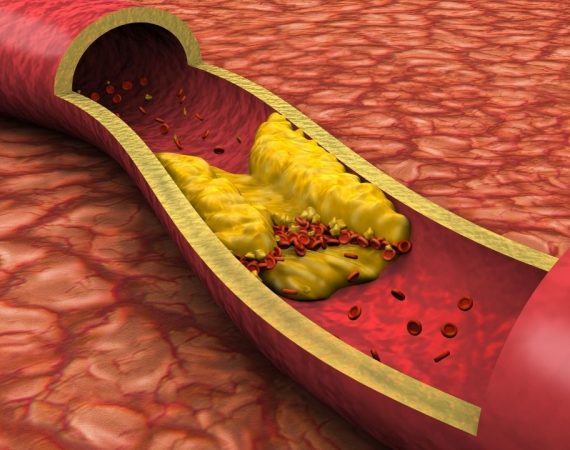 10 ALIMENTI che puliscono le ARTERIE e SALVANO il tuo CUORE